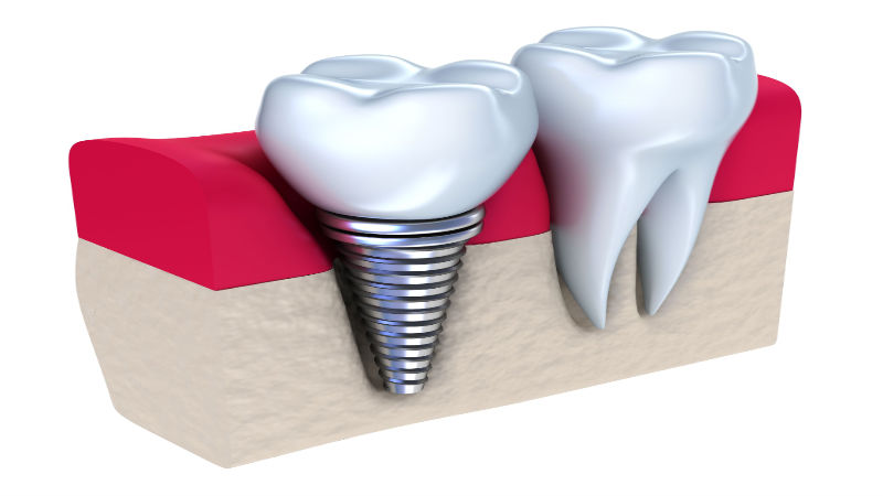 Replacing Anterior Teeth With Small Dental Implants in Salem OR