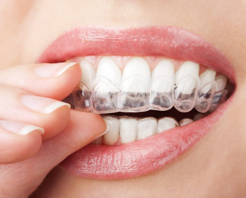 Teens Love Invisalign For Straightening Teeth