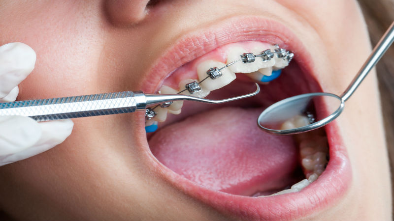 How to Install Braces At An Orthodontal Clinic In Queens, NY