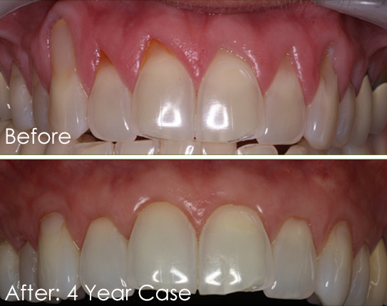 Advantages Of Pin Hole Surgery