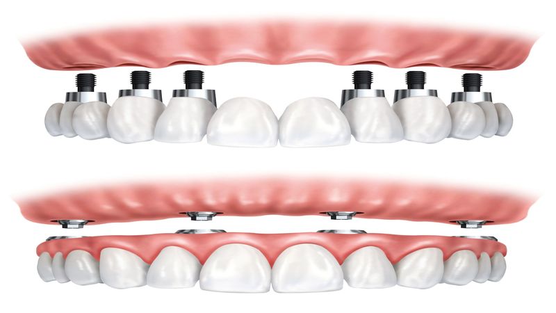 Missing Teeth Issues Can Be Fixed with Dental Bridges in Fort Myers Florida